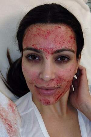 Kim Kardashian et le vampire facial