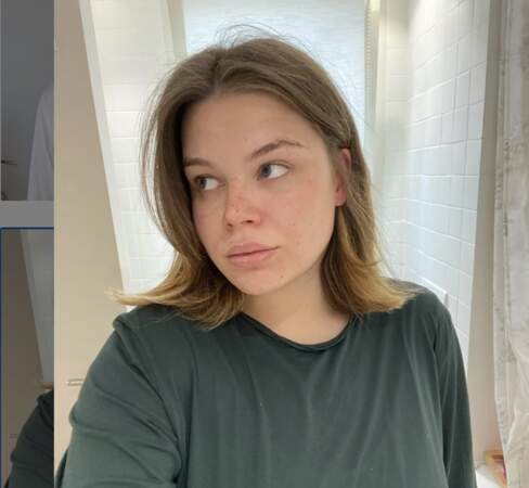 Camille Gottlieb affiche ses cicatrices d'acné sur instagram et prône le droit à ne pas être parfaite, en avril 2020.