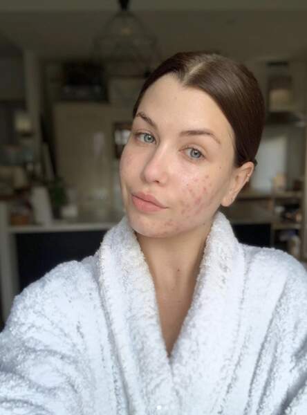 La youtubeuse Enjoyphoenix dévoile ses problèmes de peau sur son Instagram, le 12 mai 2019